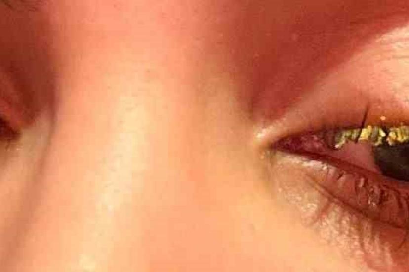 Güzellik merkezinde genç kadının gözüne yapıştırıcı kaçtı: "Kör olabilirdim"