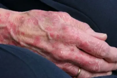 Romanya'da 40 yıl sonra cüzzam hastalığı tespit edildi